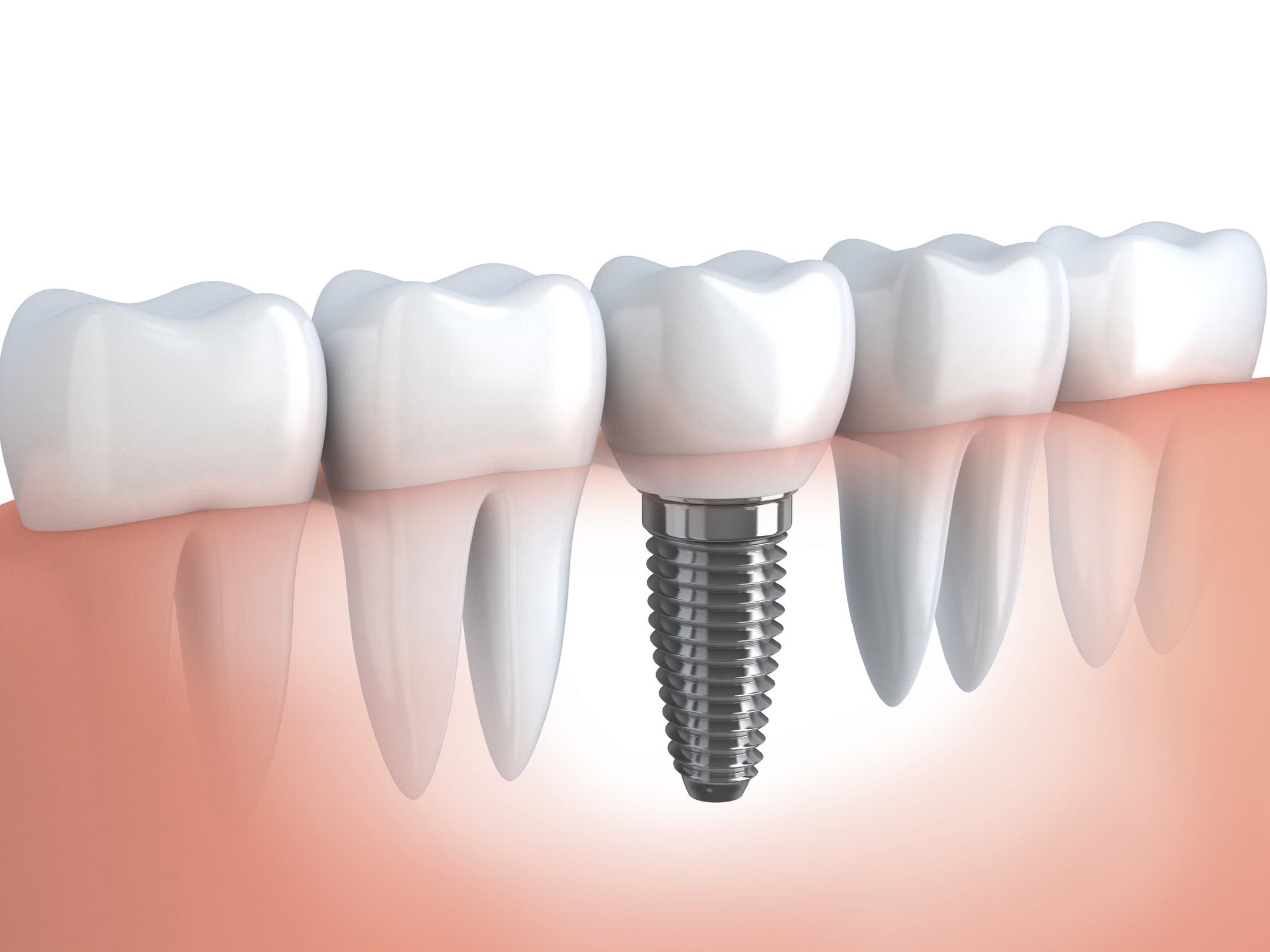 Localização dos implantes metálicos inseridos na maxila e na